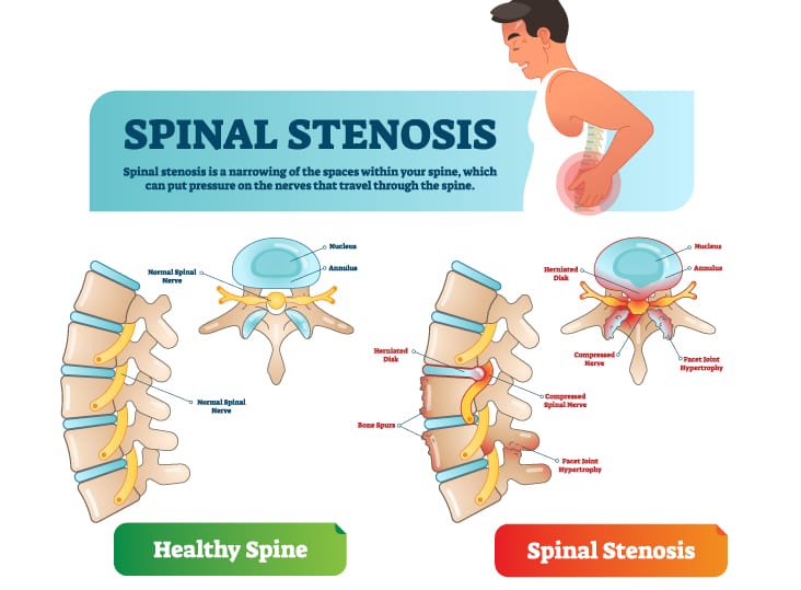 spinal stenosis yoga