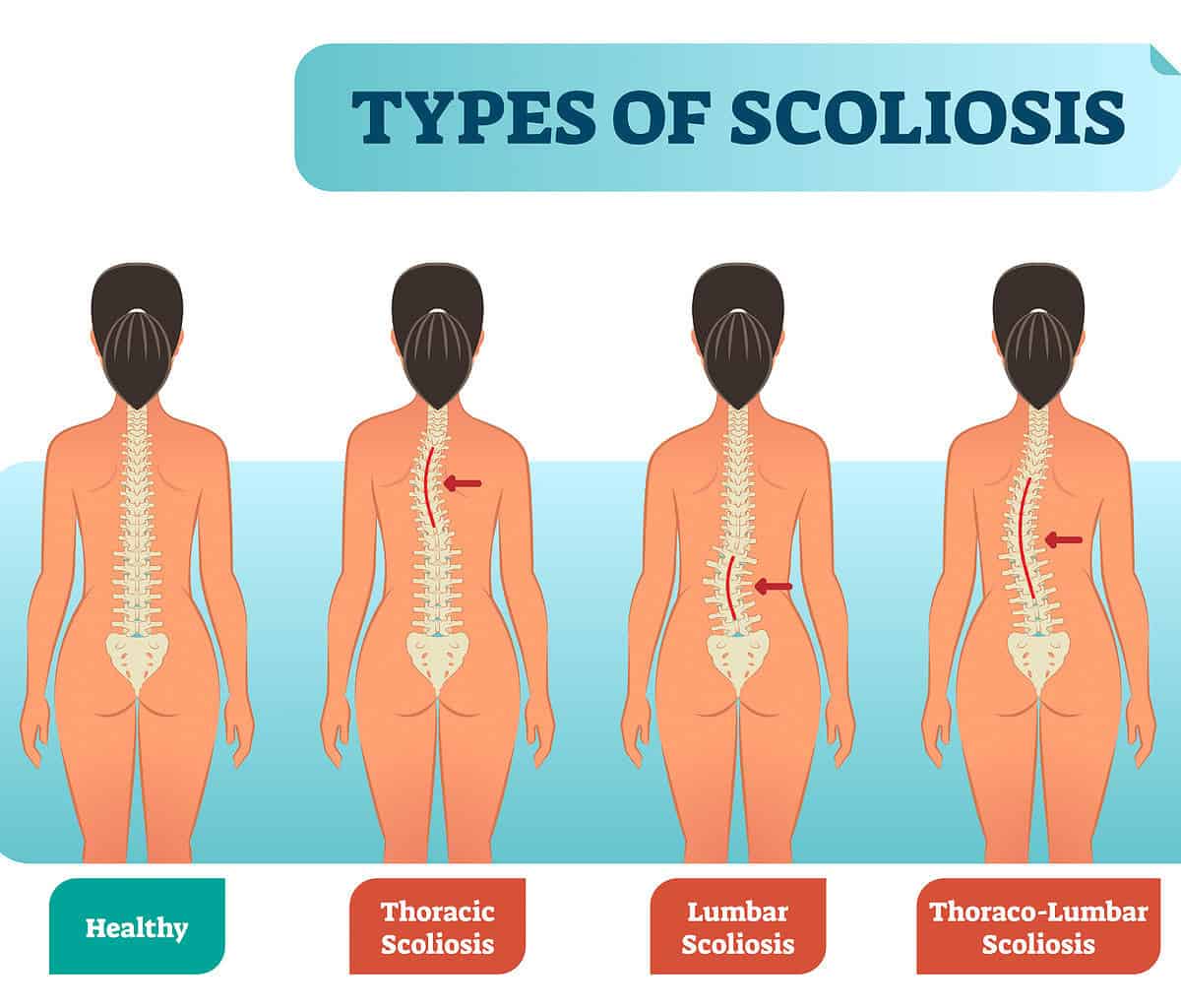 Yoga for Scoliosis